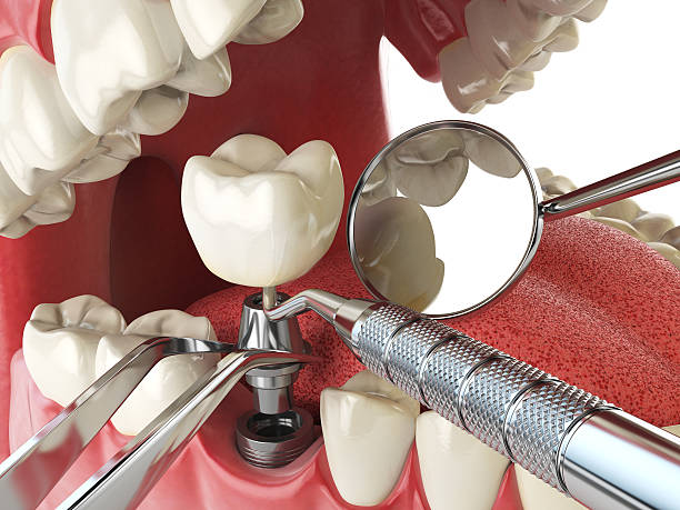 Best Emergency Dentist for Lost Fillings or Crowns in Wooster, OH